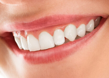 Did You Know That Teeth Whitening Results Can Last Longer With Proper Care?